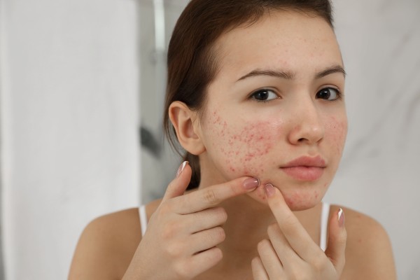 Acne – Saiba as Principais Causas e Melhores Tratamentos Dermatológicos