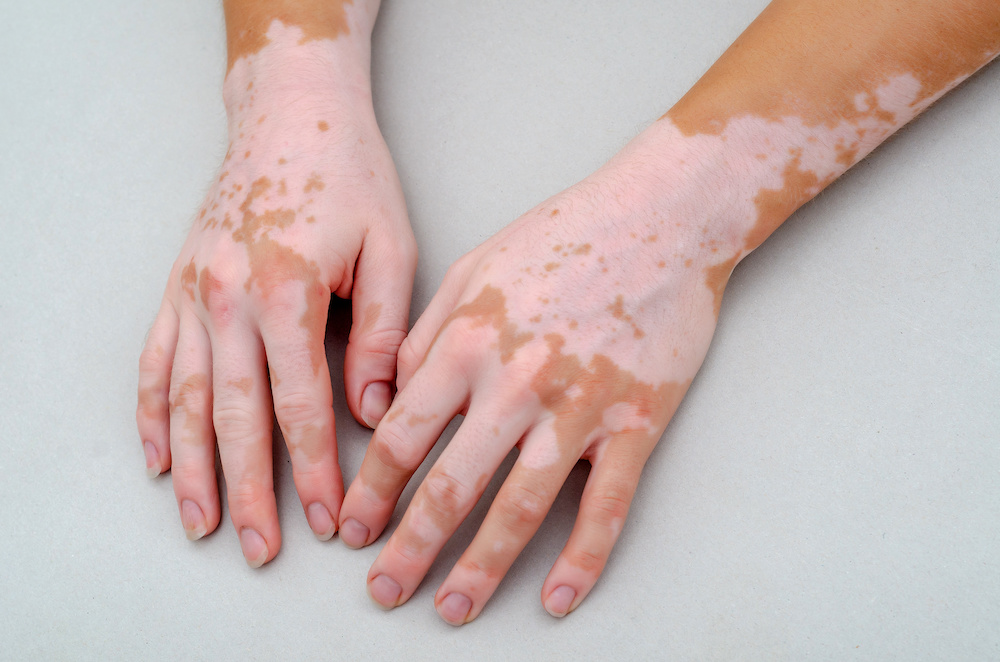 Imagem de Vitiligo