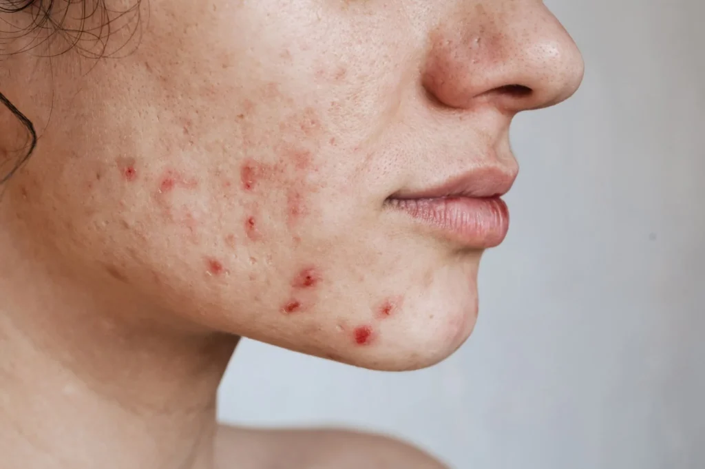 Acne: Tratando a pele e a alma