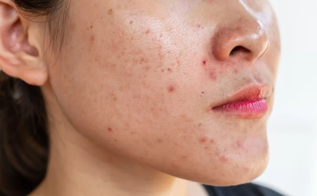 Os alimentos e a acne: como escolher o que é melhor para sua pele