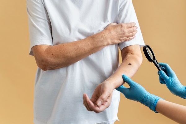 Médico, usando luvas cirúrgicas azuis , examina o braço de paciente com uma lupa. Há suspeita de câncer da pele.