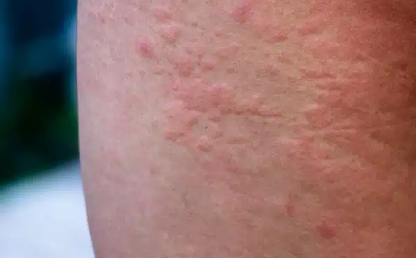 Erupções alérgicas fortes ( urticária aguda) no corpo. Alteração da imunidade e reação a produtos alérgicos.