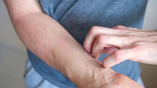 Jovem coça o antebraço vermelho irritado com a mão, sofrendo de coceira irritante na pele.
